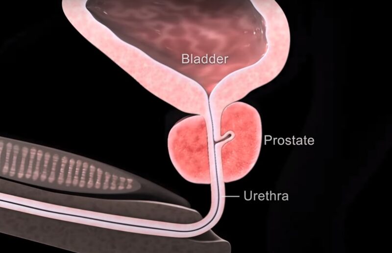 prostate-biopsy-procedure-explained-by-urologist-youtube